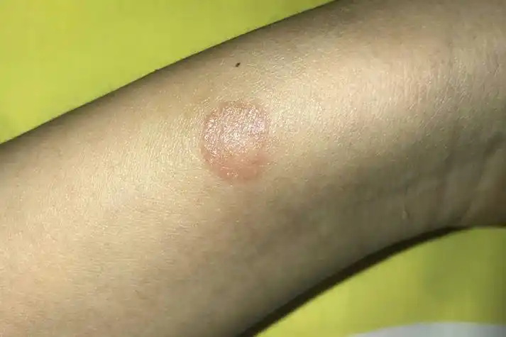 小点,以后逐渐扩展,边缘很明显,较附近的正常皮肤略微高起呈堤岸状