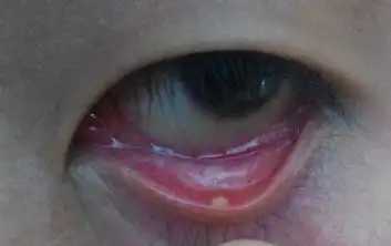 2014-04-18 张更新 医师 右眼上眼皮靠近眼角里面长了一个小白疙瘩