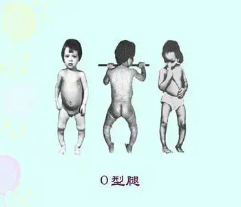 3-6岁百科    鸡胸是指胸骨向前隆起的畸形,大多鸡胸是佝偻病造成的