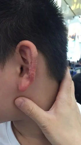 耳朵上长的是什么,是什么皮肤病吗?
