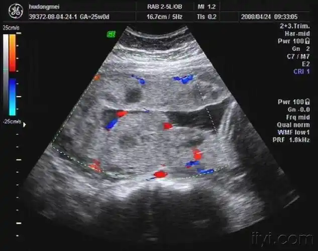 孕24周的胎盘
