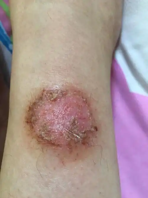 半年了,流水,不结痂!