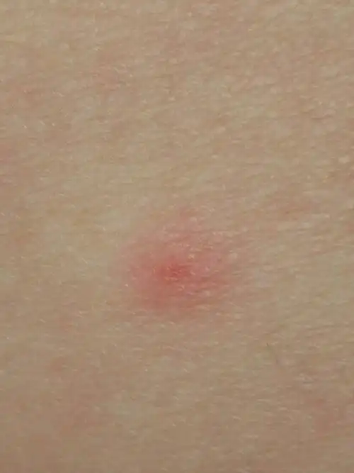 腿上起了好多这样的红点怎么办