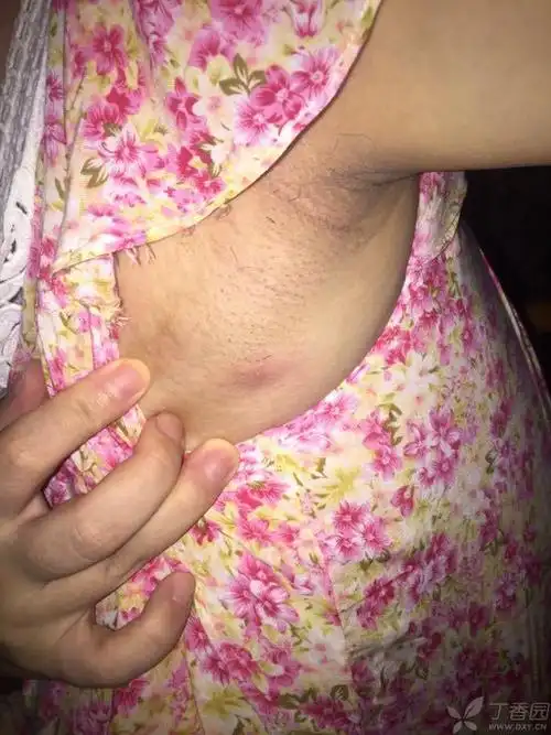 患者女,28岁,腋下有一颗黄豆大小硬块,手按它有点痛,平时不痛,这个是