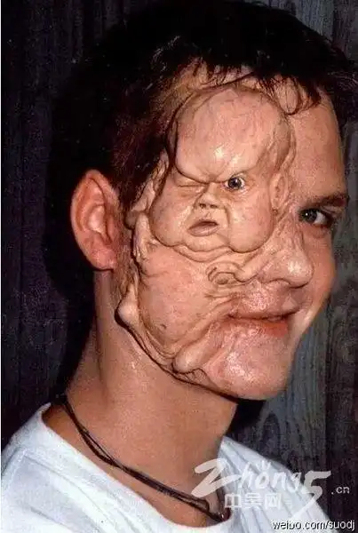 一些你没见过的怪病,非常恐怖,胆小别点