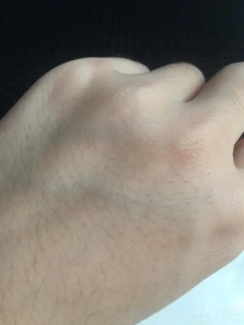 突然发现的点状白斑 - 皮肤与性传播疾病讨论版 -丁香园论坛