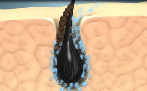 微气泡清洁毛孔示意图