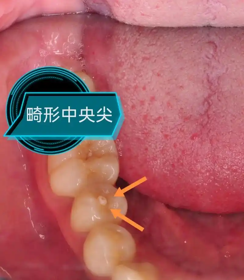 畸形中枢尖牙 - 抖音