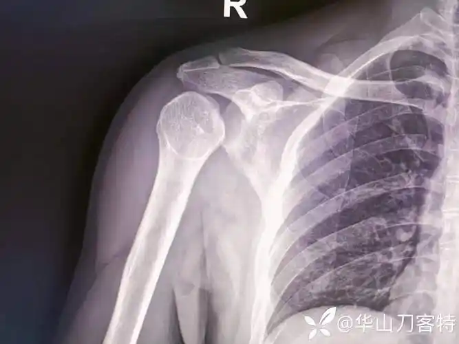 灯泡征高度提示肩关节后脱位