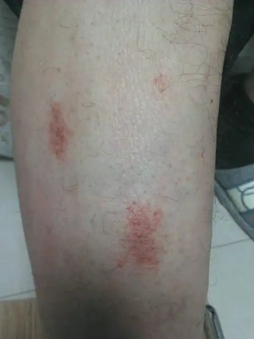 男46岁 小腿这几天出现了块状红疹,不痛不痒,因为牙疼吃过布洛芬缓释