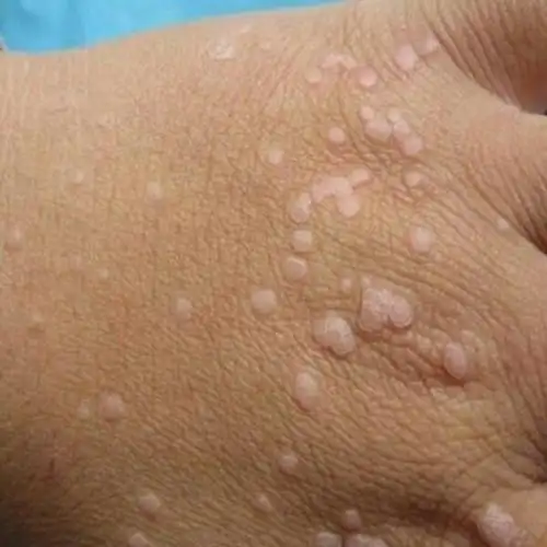 扁平疣图片_扁平疣症状表现图片大全_有来医生