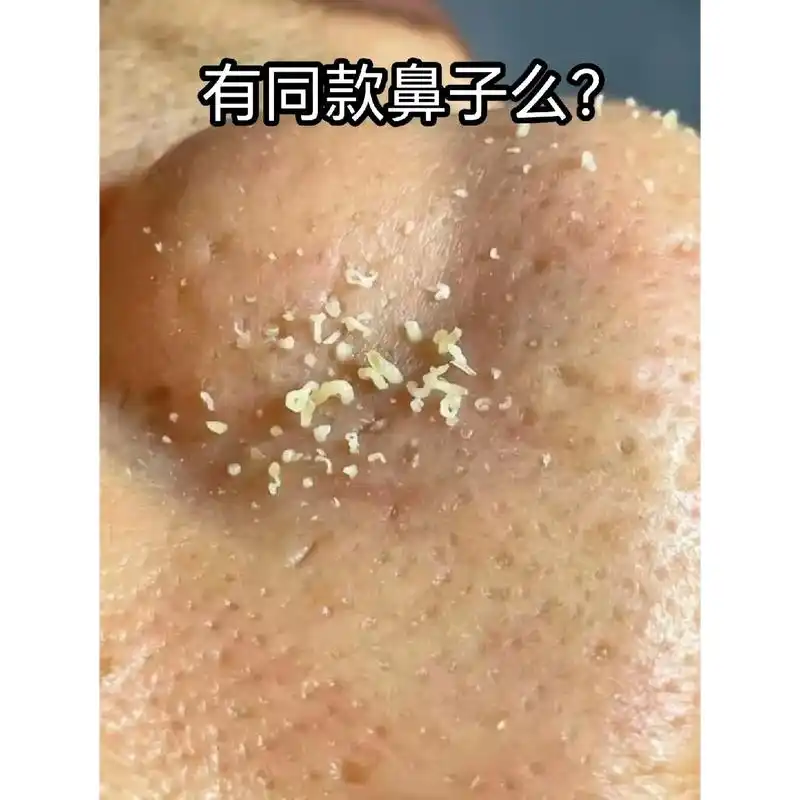 去黑头粉刺螨虫痘痘 #去黑头神器 #图文掘金计划 - 抖音