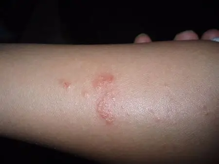 胳膊上长这样的疙瘩,还发痒,是怎么回事?跪求有医学知识的人回答!