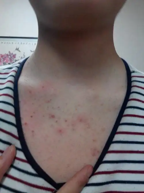 阴茎长毛囊炎的症状图片