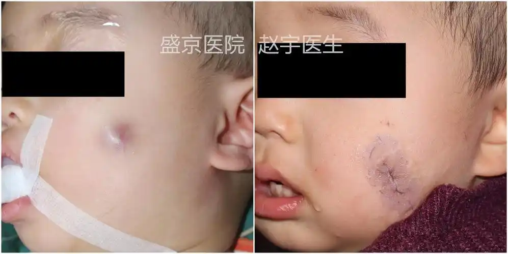 180705  上肢钙化上皮瘤_副本.jpg