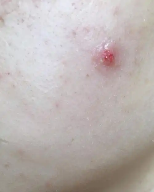 脸上长了个疣,喷了四次冰冻的.现在还是这样没好.求问怎么办?