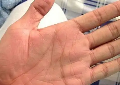 手相金星丘横纹事业操劳受婚姻影响事业发展缓慢