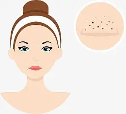 鼻子长黑头的女人