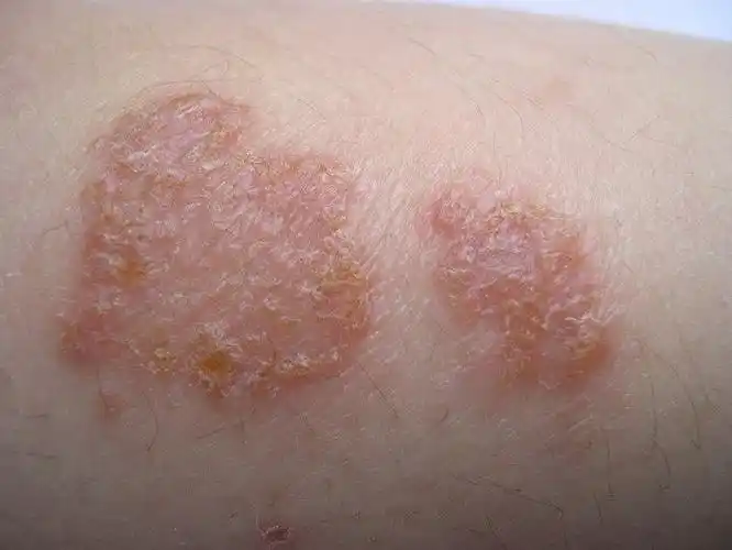 有时和接触性皮炎,虫咬性皮炎,儿童丘疹性肢端皮炎临床症状较相似,要