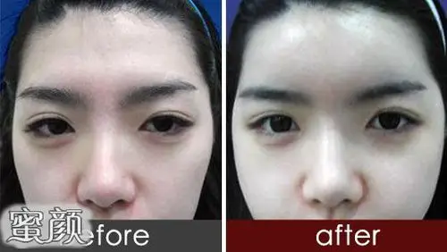 用脂肪填充,感觉术后维持时间不长,用假体丰额头又不知道该选择硅胶