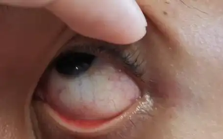 为什么眼睛有红血丝