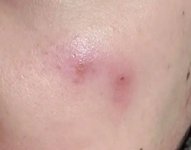 脸上有又红又硬的痘痘痒痒的按上去有点痛