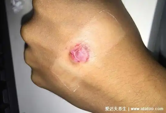 鸡眼挖出来的肉刺图,呈白色粉丝状为全部挖出(附处理方法)