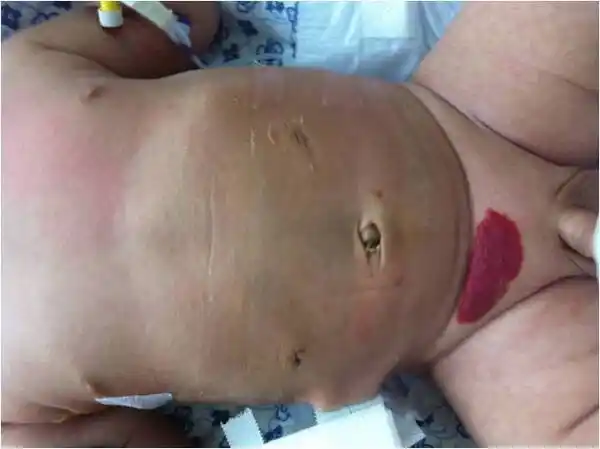 先天性幽门肥大性狭窄行腹腔镜下幽门环肌切开术