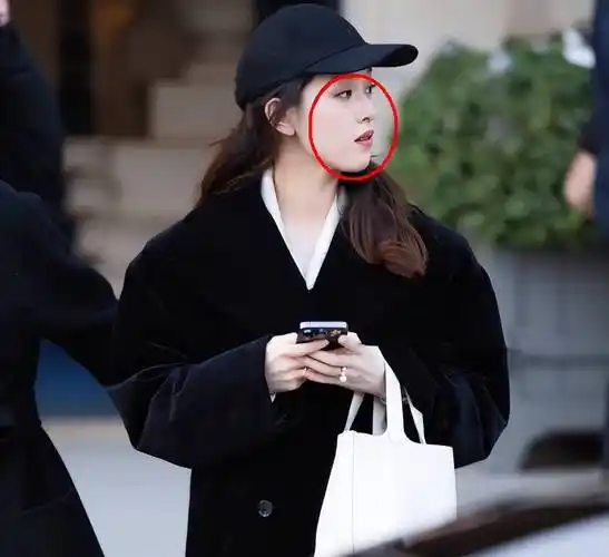 侧脸尤为明显,下巴很尖,牙齿凸显导致嘴巴都合不上.