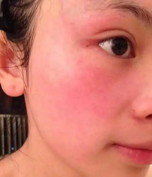 没事就红痒刺痛一不小心就过敏敏感肌我太难了