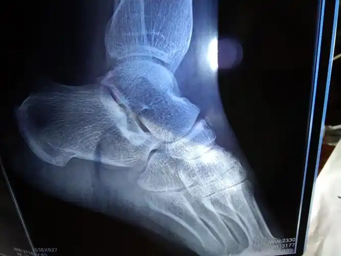 脚撕脱骨折,没固定,一个多月了还是肿痛,分别拍了片子,现在的片子愈合