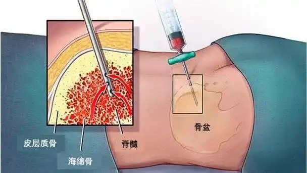 穿刺时患者的体位取决于选定哪个部位为穿刺点,从髂前上嵴和胸骨穿刺