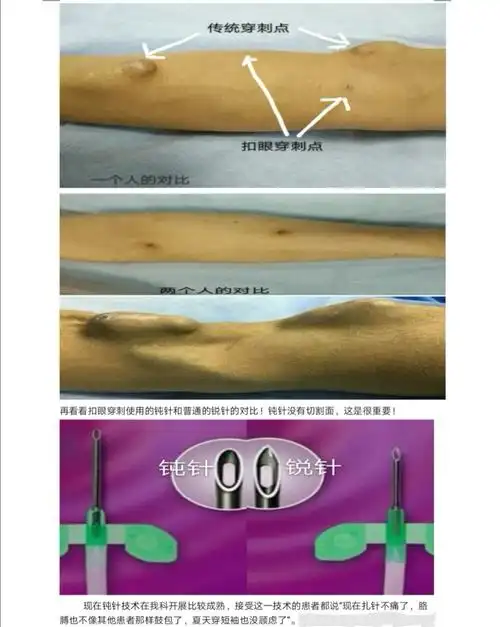 "扣眼"解决了透析患者穿刺的痛苦 - 美篇