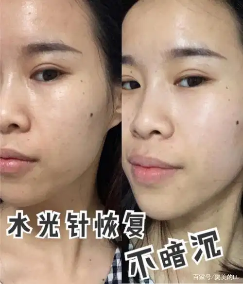 水光针恢复对比图