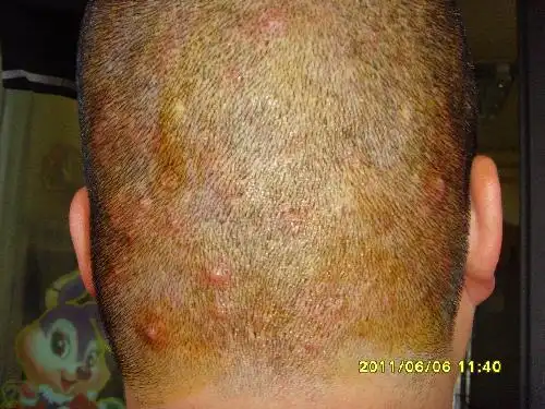 头部脂溢性皮炎(或者其他病)一直不好.求根治良方