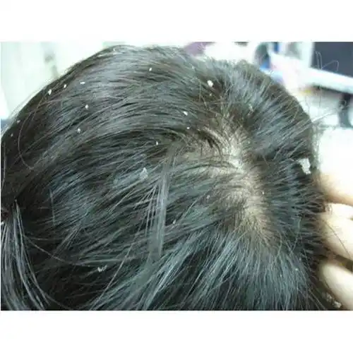 头皮毛囊炎用啥样的洗发水合适