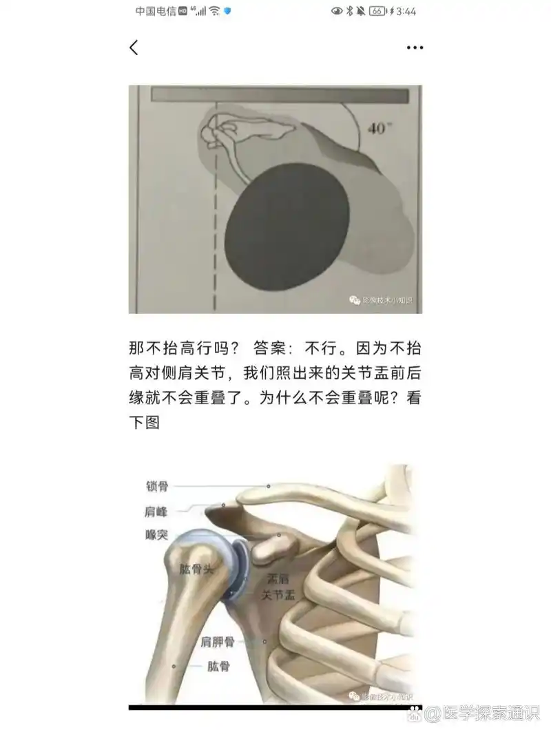 如何拍出标准的肩关节正位 大家看图