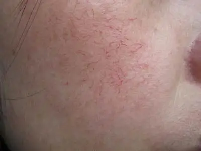 治疗红血丝较好的医院是哪家