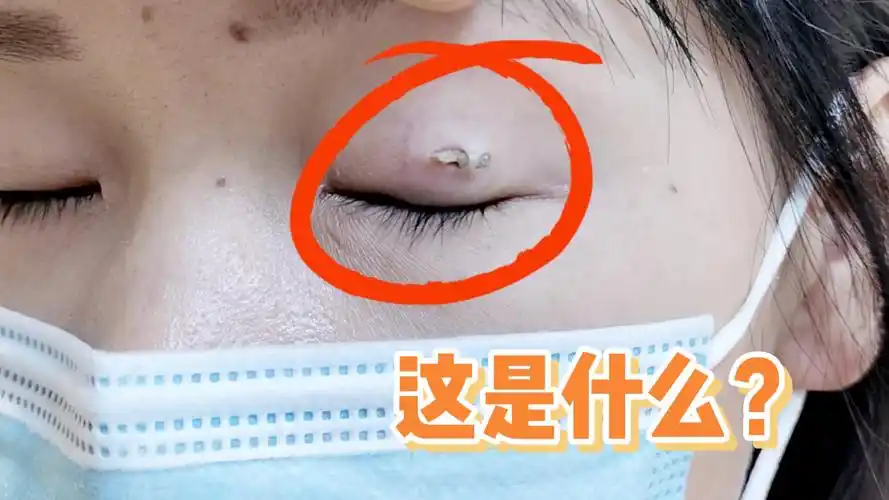 小仙女做完埋线后产生的线结反应,没有及时