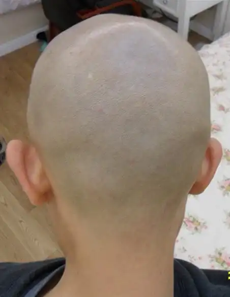 直接上图露脸,自己用吉利锋速3刮光头,一点没破.