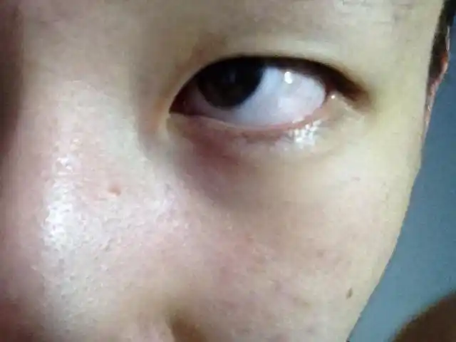 眼睛总有红血丝,有时感觉酸痛,尤其是刚吃完饭时,眼睛有烧灼感,眼皮