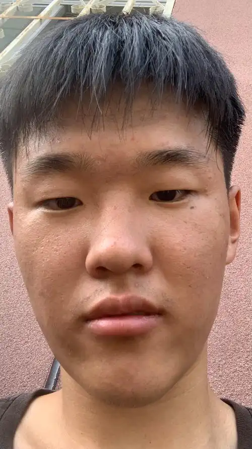 面部状态巨差痘痘痘印闭口粉刺,面部发红发黑暗沉,脸比脖子黑