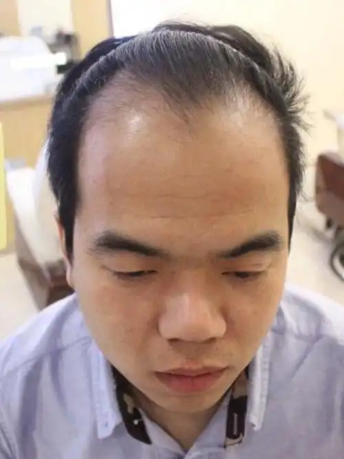 植发前必看真人案例===秃头的转变