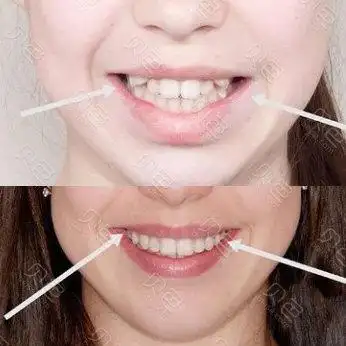 "虎牙妹变形记"搞定两颗虎牙从此土包子变小仙女