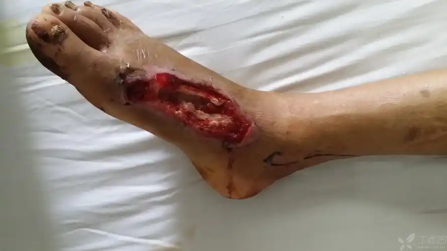 这个足背皮肤缺损该用什么皮瓣啊? [病例帖]