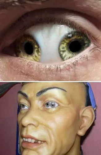 现实中的"写轮眼":那些重口味的特异眼病