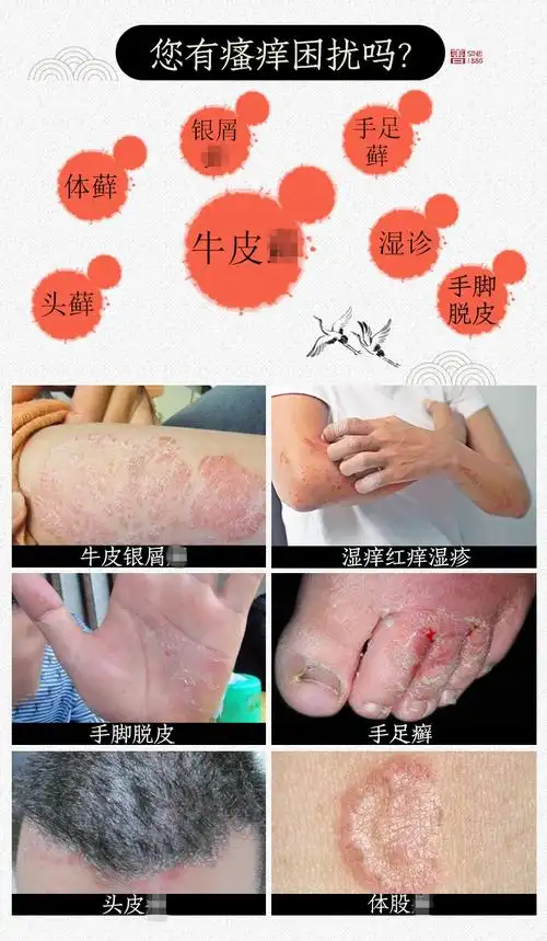 银敌搽剂抑菌液 4*30ml 皮肤痒顽固瘙痒牛皮银屑外用止痒喷剂藓清癣清