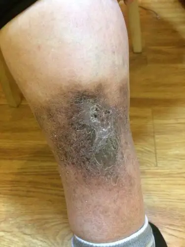 小腿慢性溃疡,静脉曲张(一例),高女士,60岁,在欧洲城卓越国际少儿英语