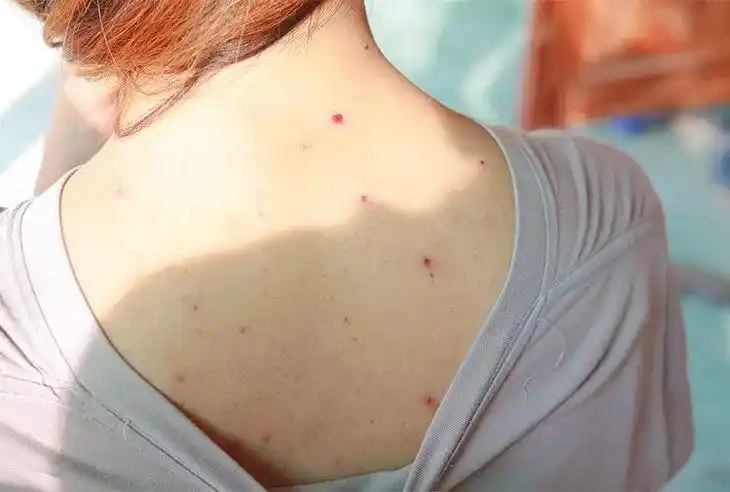 性感后背是女人的武器,别被痘痘毁了_皮肤