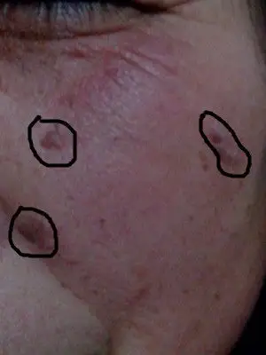 我妈近年来脸上长了这样的肉疙瘩,还会蔓延请问下这是什么皮肤问题?